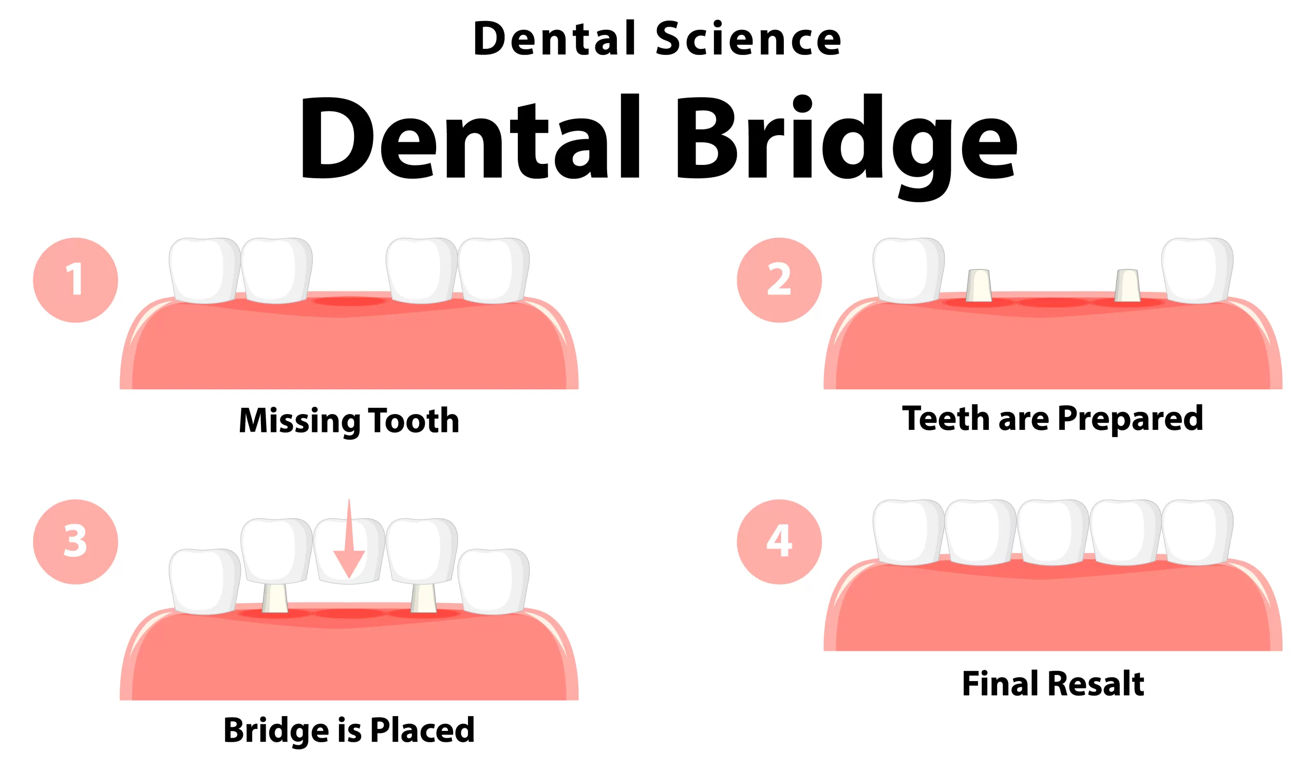 Dental bridge treatment to replace missing teeth